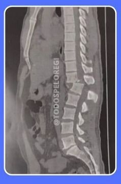 Tomografia de Regilaneo da Silva Inácio após ser atingido por um aparelho de musculação / Reprodução