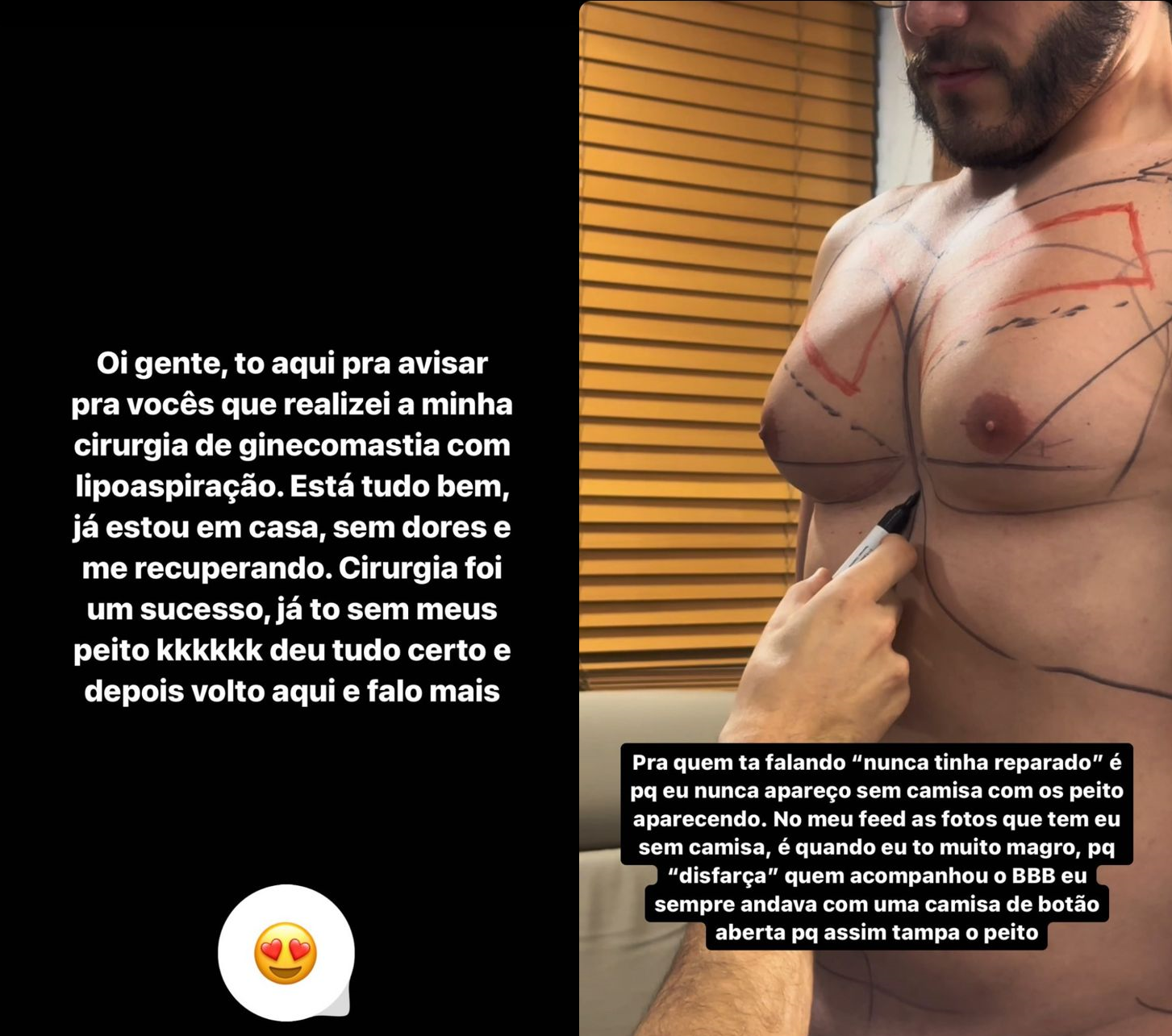 Eliezer mostrou no Instagram alguns processos da cirurgia de ginecomastia / Reprodução/Eliezer/Instagram