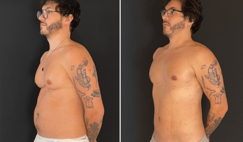 Eliezer exibe "antes e depois" do corpo após cirurgia de ginecomastia / Reprodução/Instagram