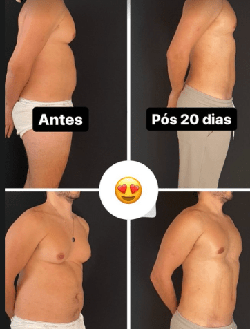 Eliezer exibe "antes e depois" do corpo após cirurgia de ginecomastia / Reprodução/Instagram