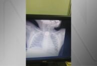 Criança fica engasgada com moeda e desmaia em ônibus no Rio