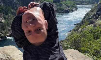 "Não vejo nada de cabeça para baixo", diz baiano portador de rara doença congênita