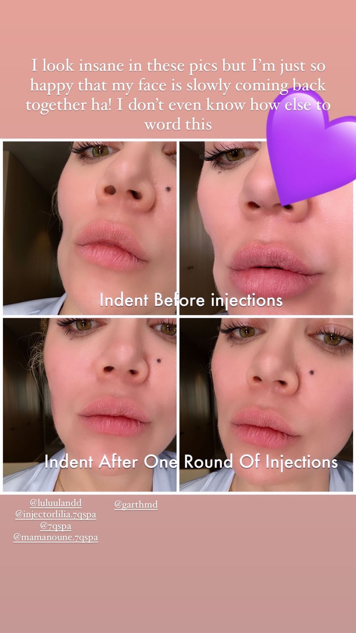 Khloé mostra diferença no rosto após retirada de tumor / Reprodução/Khloé Kardashian/Instagram