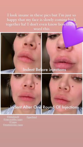 Khloé mostra diferença no rosto após retirada de tumor / Reprodução/Khloé Kardashian/Instagram