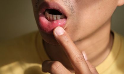Causas da afta na boca