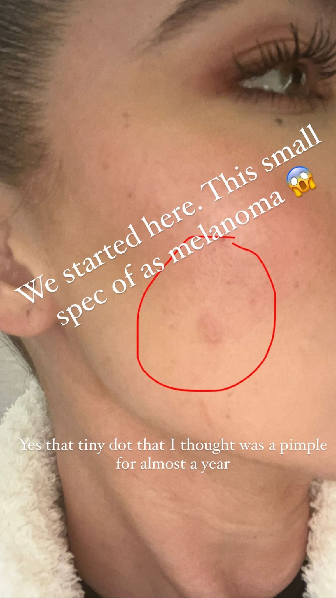 Khloé disse que achava que pontinho na pele era apenas uma espinha / Reprodução/Khloé Kardashian/Instagram