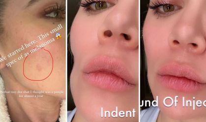 Khloé Kardashian mostra antes e depois de remoção de câncer de pele no rosto