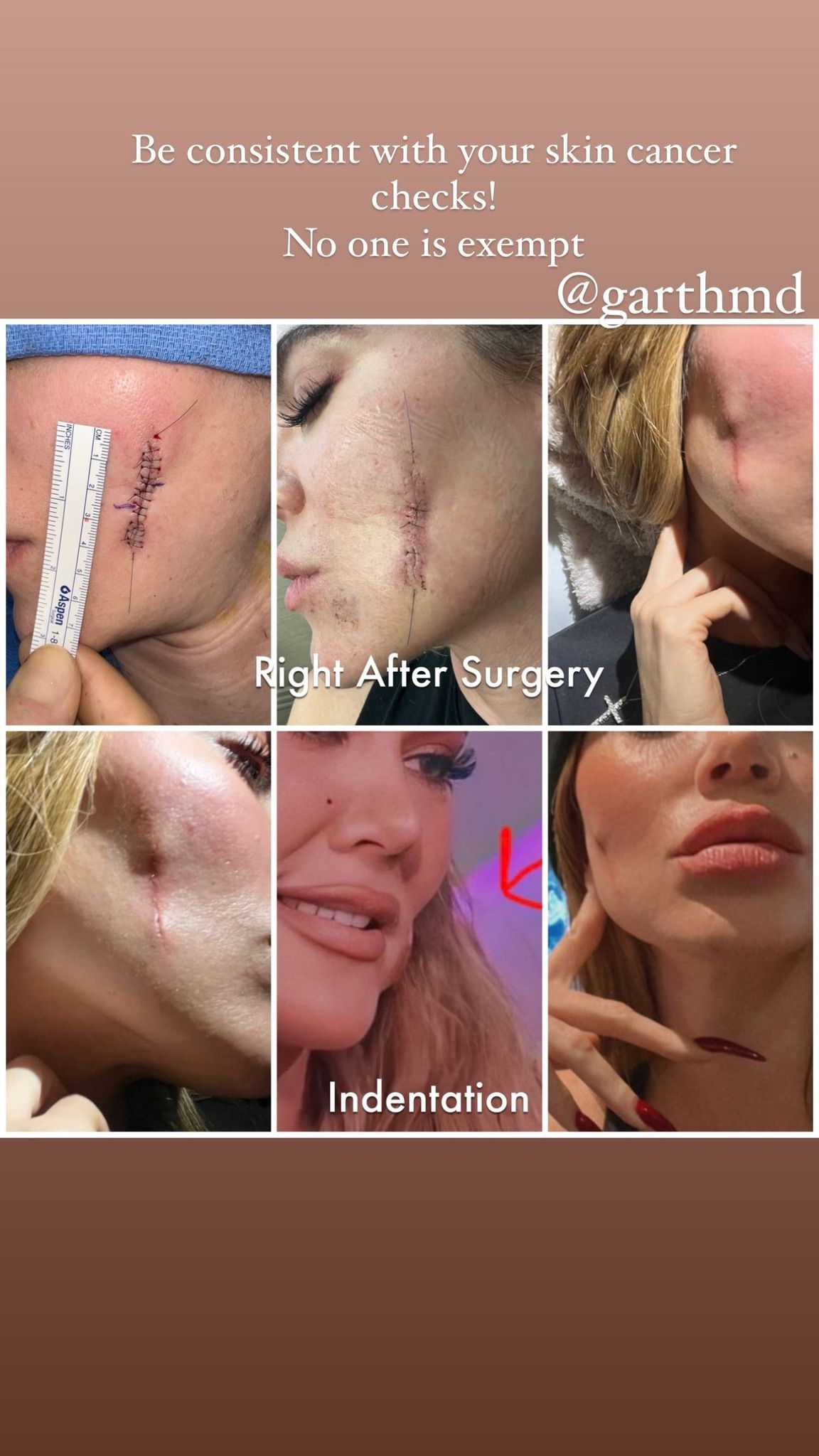 Khloé mostra diferença no rosto após retirada de tumor / Reprodução/Khloé Kardashian/Instagram