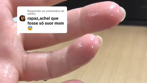 Imagem de destaque do post: Jovem viraliza com suor excessivo nas mãos; médico explica o que fazer na onda de calor