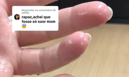Jovem viraliza com suor excessivo nas mãos; médico explica o que fazer na onda de calor