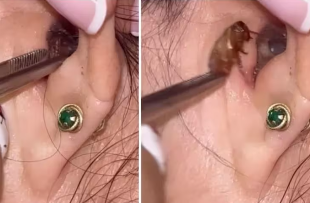 Imagem de destaque do post: Médica tira barata do ouvido de paciente e viraliza; saiba o que fazer em situação semelhante