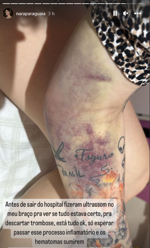 Namorada de Toguro mostra hematomas no braço / Reprodução/Instagram