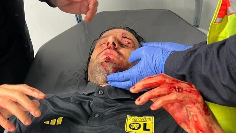 Técnico do Lyon foi atingindo por pedra no rosto