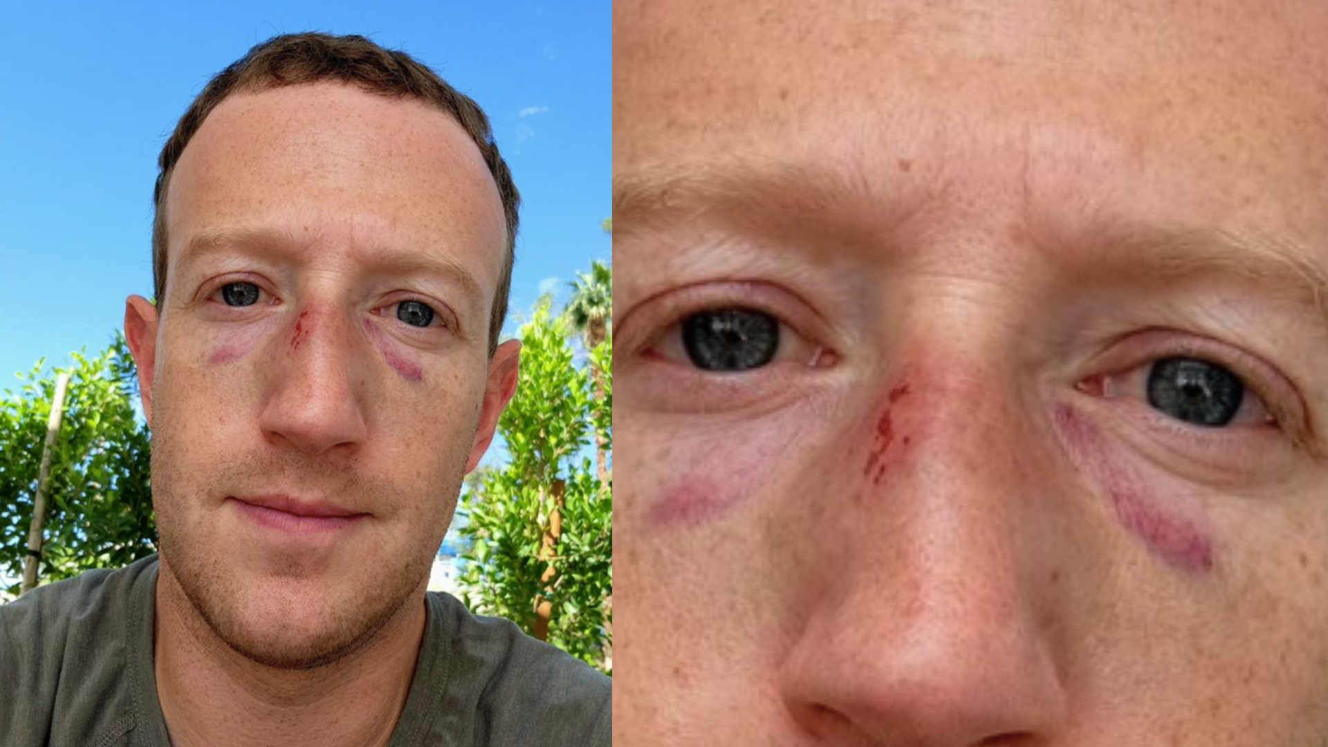 Mark Zuckerberg publica foto com hematomas