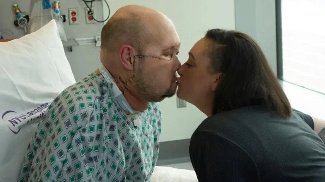 Aaron James e sua esposa Meagan se beijam pela primeira vez após a cirurgia de transplante de olho e parcial rosto / NYU Langone Health