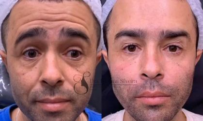 Motorista que atropelou Kayky Brito faz harmonização facial e mostra resultado