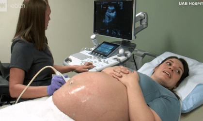 Mulher com condição genética rara fica grávida em dois úteros