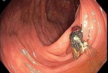 Médicos encontram mosca viva dentro de intestino de paciente durante exame
