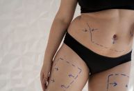 Lipoaspiração emagrece? Especialistas explicam mitos e verdade