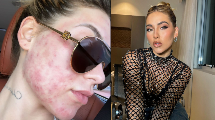 virginia-acne-mulher-adulta-entenda