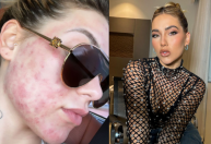 Virginia Fonseca enfrenta acne da mulher adulta; entenda a condição