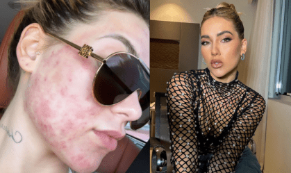 Virginia Fonseca enfrenta acne da mulher adulta; entenda a condição