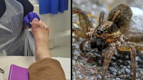 Dedo do turista britânico Colin Blake ficou inchado após ele afirmar ter sido mordido por aranha