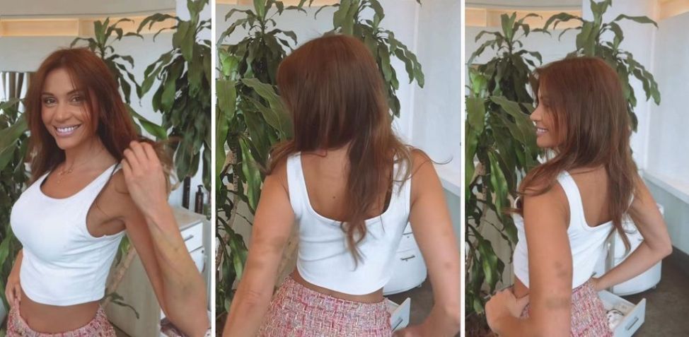 Na imagem é possível ver hematomas no braço da ex-BBB Maria Melilo / Reprodução/Rede Social