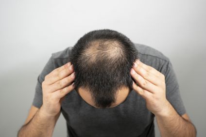 Cresce procura por transplante capilar por pessoas acima de 60 anos