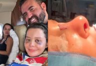 Maraisa mostra hematomas de acidente que causou fratura no nariz; veja