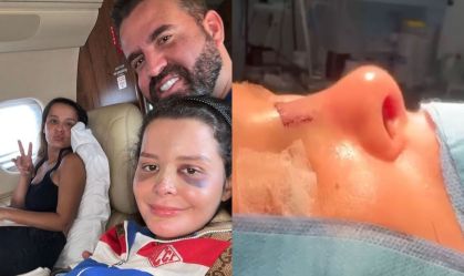Maraisa contou sobre acidente aos fãs após fraturar o nariz durante folga
