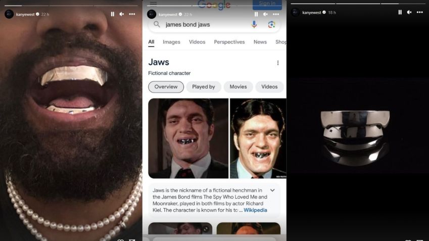 Stories de Kanye West mostrando a prótese de titânio. / Reprodução/ Instagram