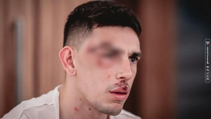 Gonzalo Escobar levou diversos pontos no rosto após ser atingido no ataque ao ônibus do Fortaleza