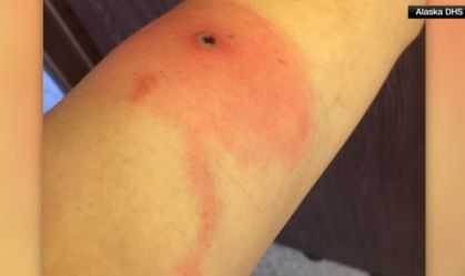 Varíola do Alasca: o que é a doença que matou uma pessoa nos EUA