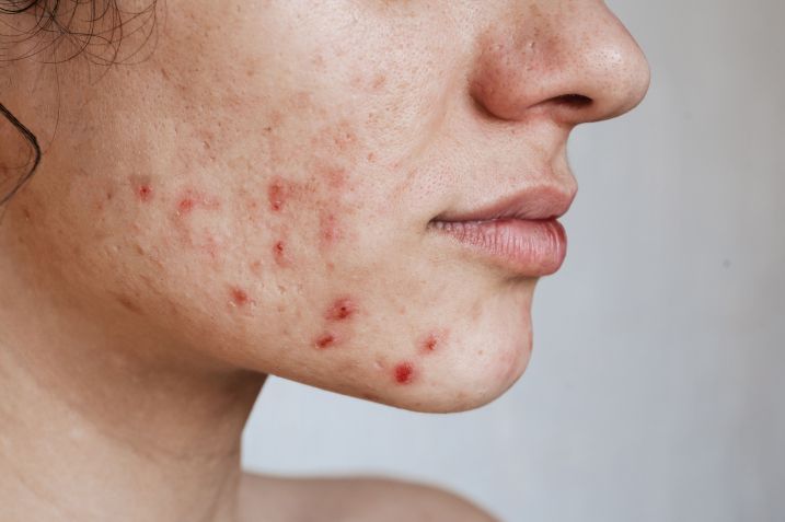 Alimentação pode influenciar no aumento da acne / Getty Images