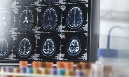 Cientistas descobrem como "ouvir" sintomas de Alzheimer; entenda