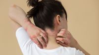 "Psoríase não é contagiosa": médica alerta para impactos do preconceito