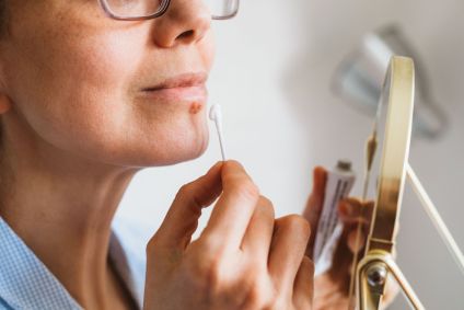 Mulher aplicando pomada em feridas causadas pelo herpes labial