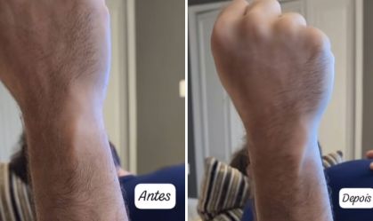Kayky Brito mostra resultado de fisioterapia no braço