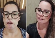 Influencer perde lábios e fica com rosto deformado após procedimento de harmonização dar errado