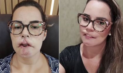 Médico encontra PMMA em cirurgia de influencer que perdeu os lábios no interior de SP