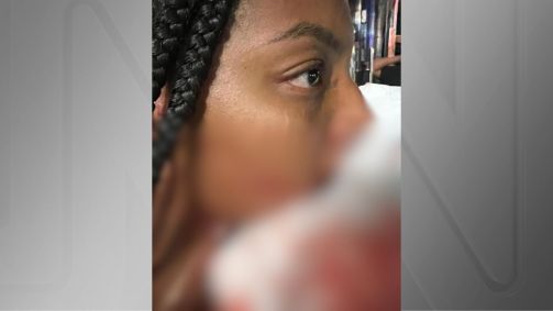 A Polícia Militar foi acionada e socorreu Alessandra no posto de saúde da Lapa, na Zona Oeste da capital, onde recebeu oito pontos nos lábios superiores e quatro dos inferiores para tratar o ferimento