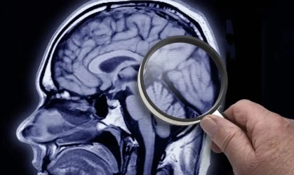 Alzheimer: IA identifica fatores de risco com 7 anos de antecedência