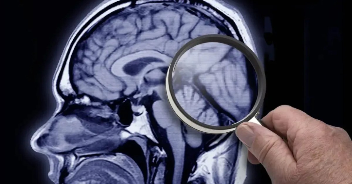 Teste rápido pode prever risco de Alzheimer décadas antes dos sintomas