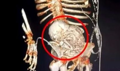 "Bebê de pedra": idosa descobre feto calcificado e morre após cirurgia no MS