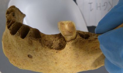 Por que nossos ancestrais não tinham cáries? Novo estudo ajuda a explicar