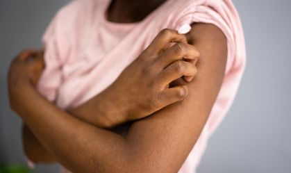 Dermatite atópica: saiba o que é a doença que teve data de conscientização aprovada