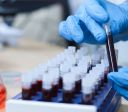 Exame de sangue para Alzheimer auxilia no diagnóstico precoce e tratamento
