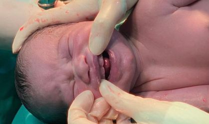 Bebê nasce com dentes e surpreende equipe médica no Mato Grosso do Sul