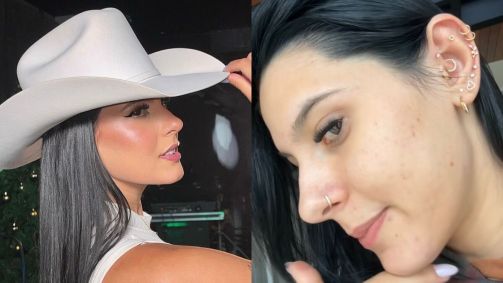 Montagem com fotos da cantora Ana Castela maquiada e mostrando a diminuição de acne na pele